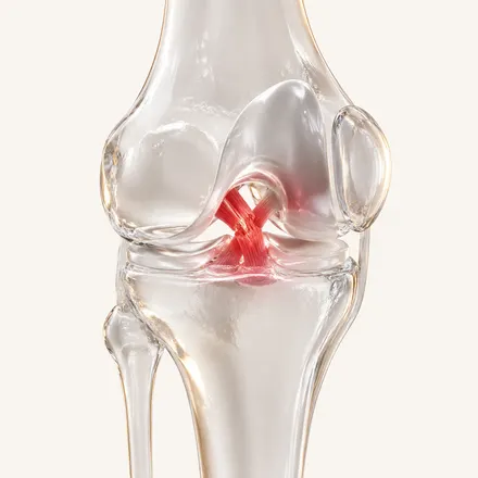 ACL Injury & Rehabilitation - condition treatment at AvaTrita