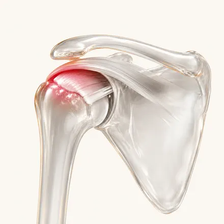 Rotator Cuff-related problems - condition treatment at AvaTrita