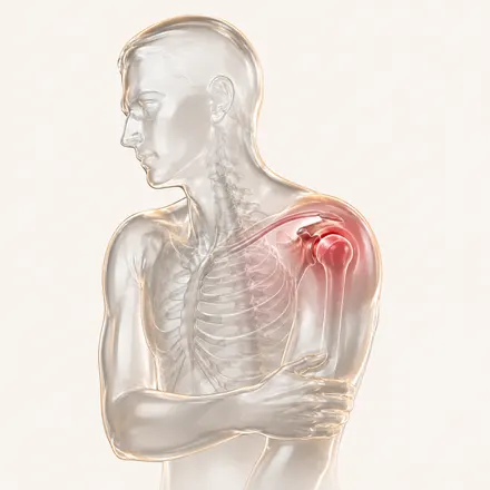 Shoulder Conditions - condition treatment at AvaTrita