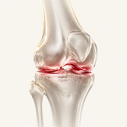 Knee Osteoarthritis - condition treatment at AvaTrita